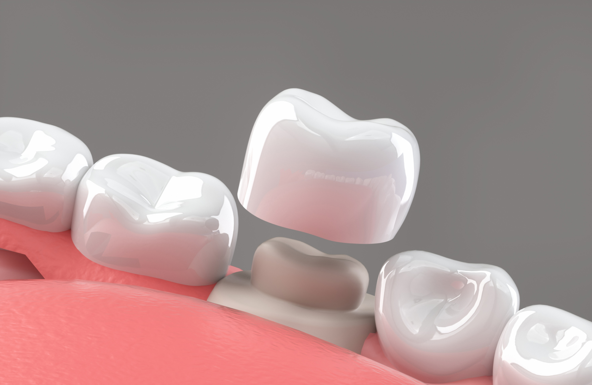 セラミック治療