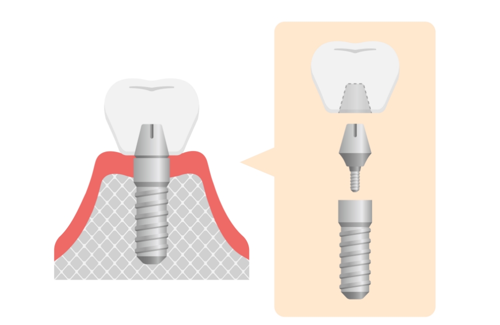 インプラントの構造