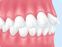 要チェック！矯正が推奨される歯並び
