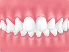 要チェック！矯正が推奨される歯並び