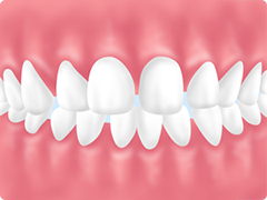要チェック！矯正が推奨される歯並び