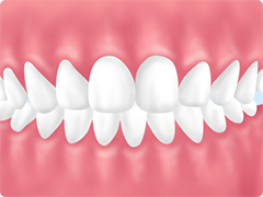 要チェック！矯正が推奨される歯並び